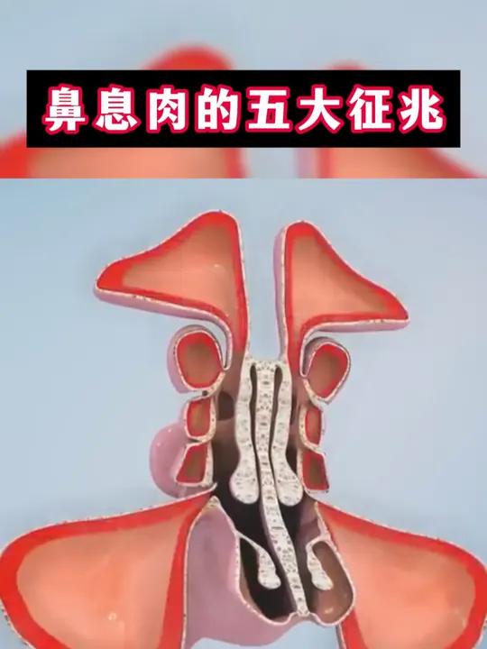 鼻息肉的五大征兆,让你早发现早治疗!你知道吗?鼻息肉的信号可别忽视!快来看看这五大征兆吧!