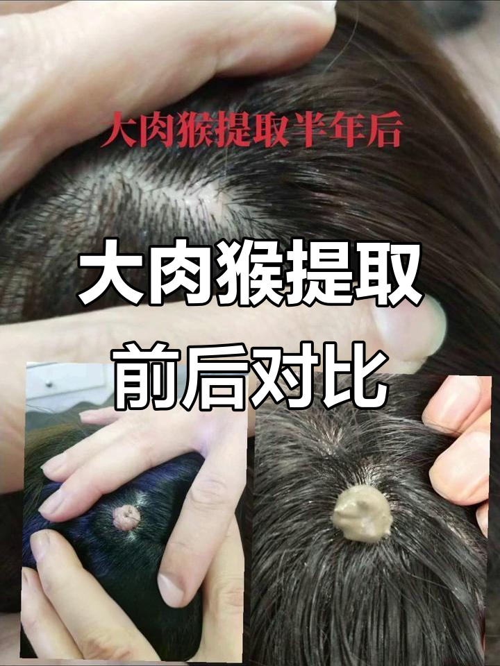 半年头发长出,头上大肉猴成功去除