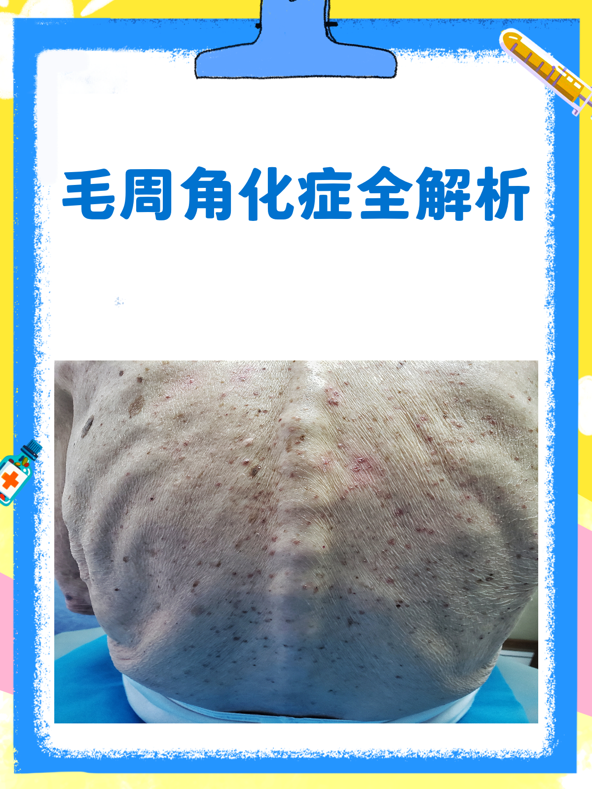 毛周角化症,你的“鸡皮肤”有救了!