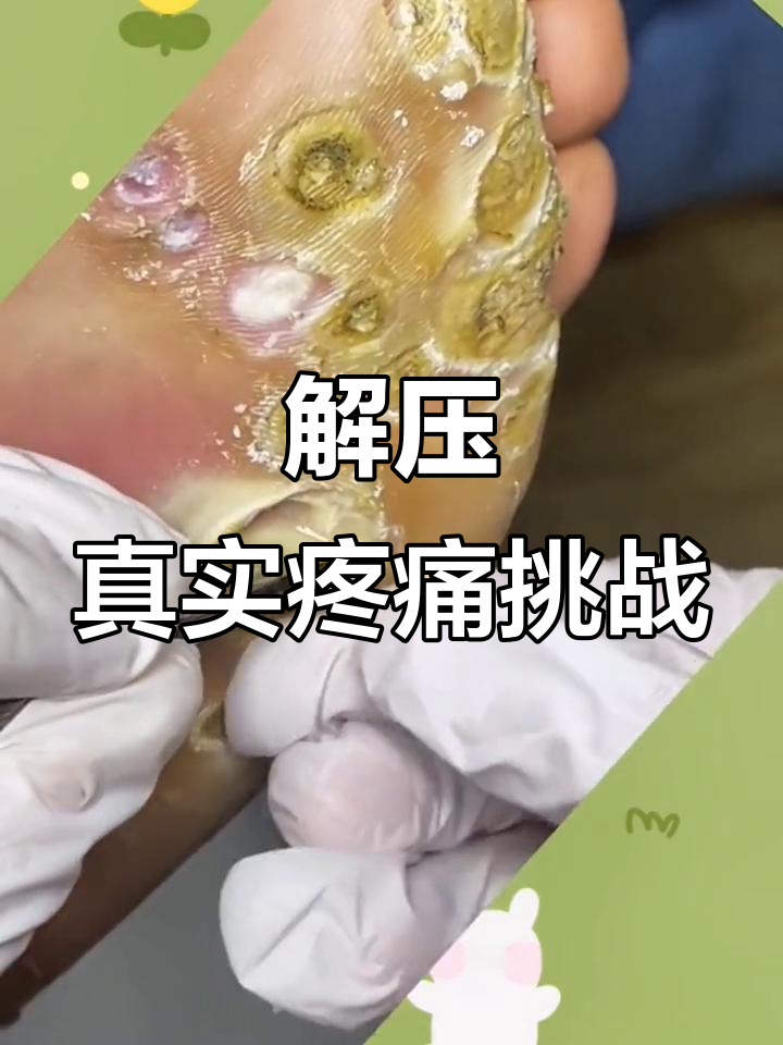 鸡眼还是阵英?疼痛难忍的真实体验