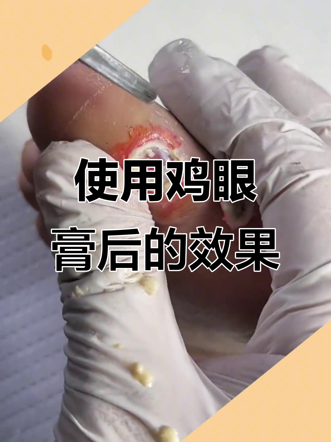 鸡眼膏使用效果大揭秘，皮肤变化看得见