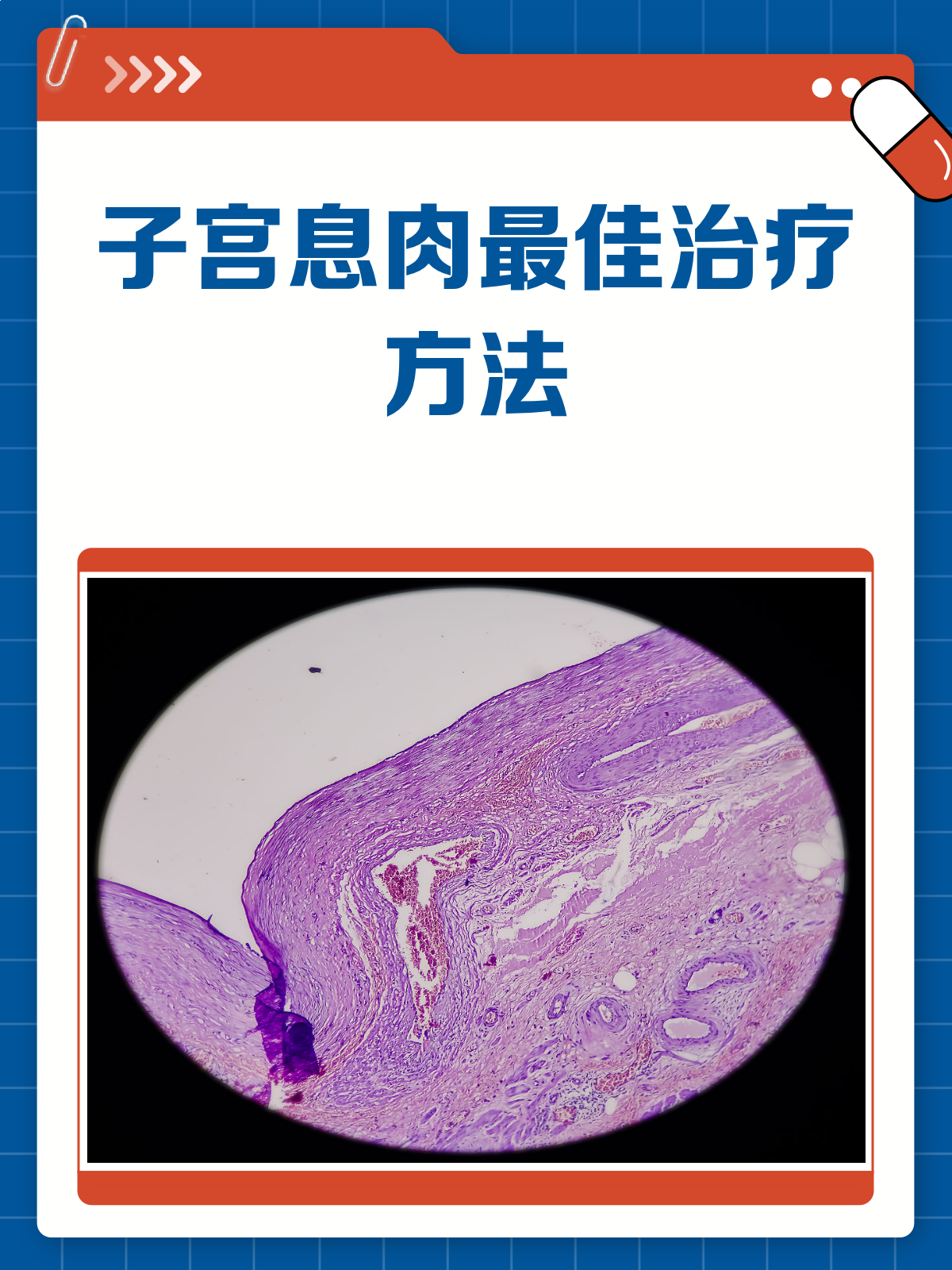子宫息肉怎么治疗?这些方法帮你快速解决!