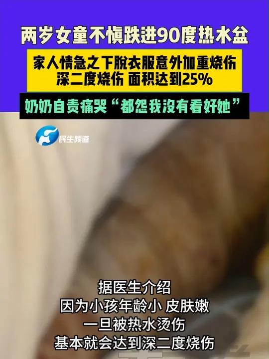 4月5日(发布)河南郑州,两岁女童不慎跌进90度热水盆。家人情急之下脱衣服意外加重烧伤,深