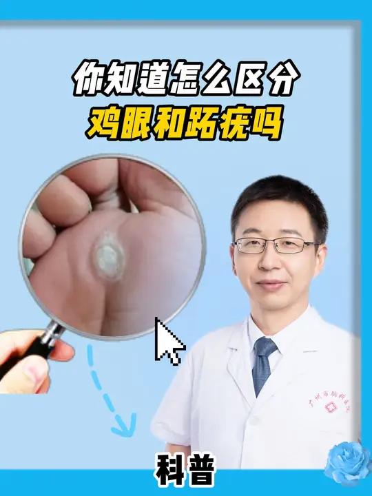 脚上长的硬疙瘩可不一定是鸡眼,你知道怎么区分吗
