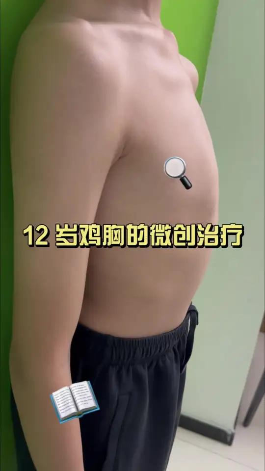 12 岁鸡胸手术微创治疗