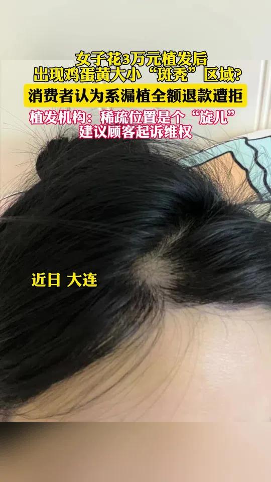 女子花3万元植发后,出现鸡蛋黄大小“斑秃”区域?消费者认为系漏植全额退款遭拒;植发机构:稀