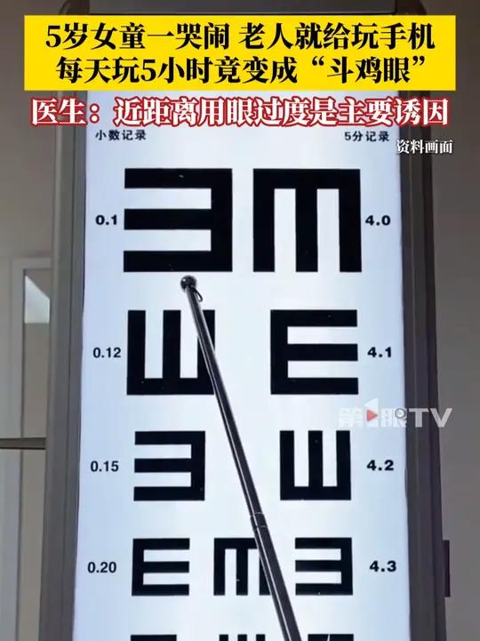 一哭闹就给玩手机,5岁女童每天玩手机5小时竟变成“斗鸡眼”。医生提醒:3-6岁孩子每天电子