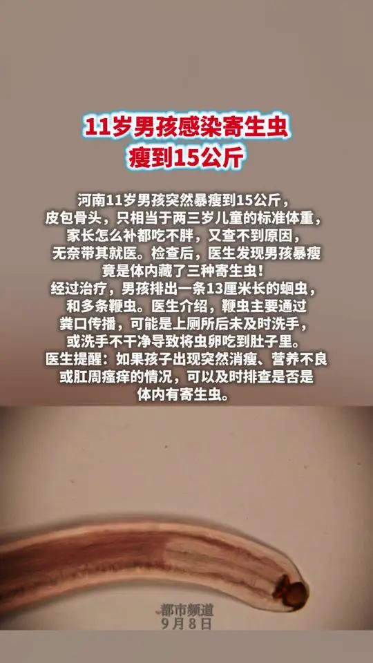 11岁男孩感染寄生虫瘦到15公斤   9月7日,河南11岁男孩突然暴瘦到15公斤,皮包骨头