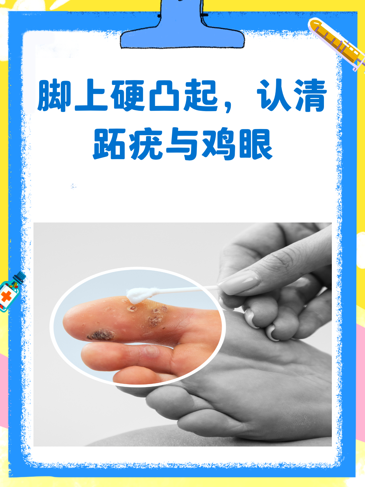 脚上硬凸起?揭秘跖疣、鸡眼的真相!