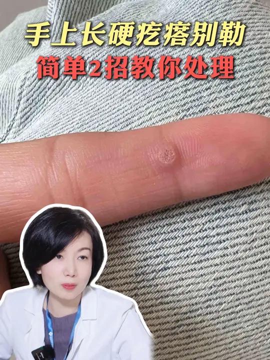 你手上长过这种肉疙瘩吗?千万别去勒!三甲医生教你处理