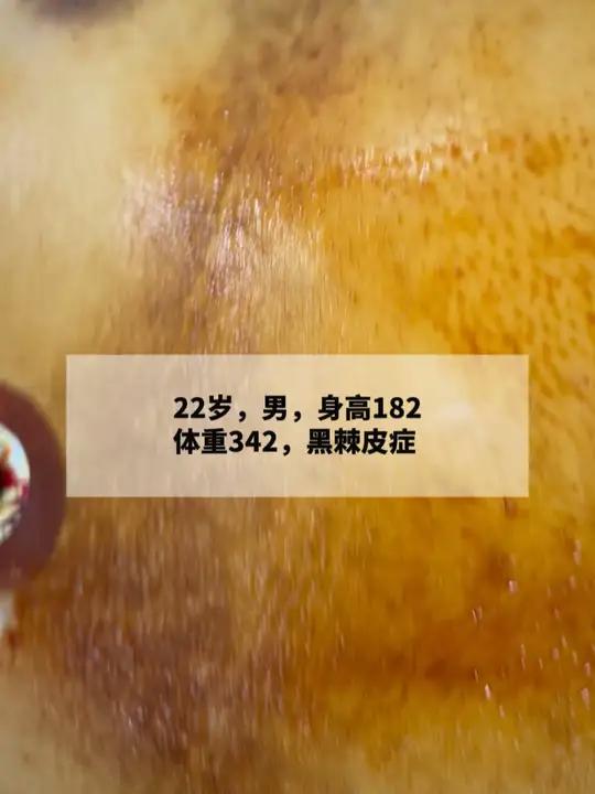 22岁,身高182,体重342,让我们看看具体黑棘皮症的表现。黑棘皮症 肥胖 减重代谢 作