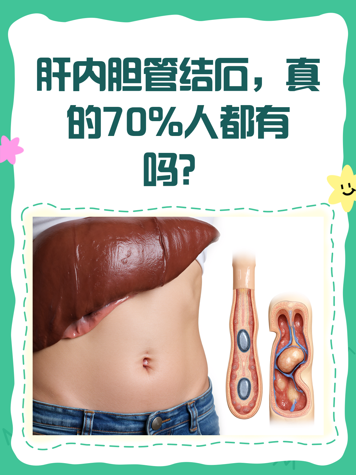 肝内胆管结石,真的有70%的人会中招吗
