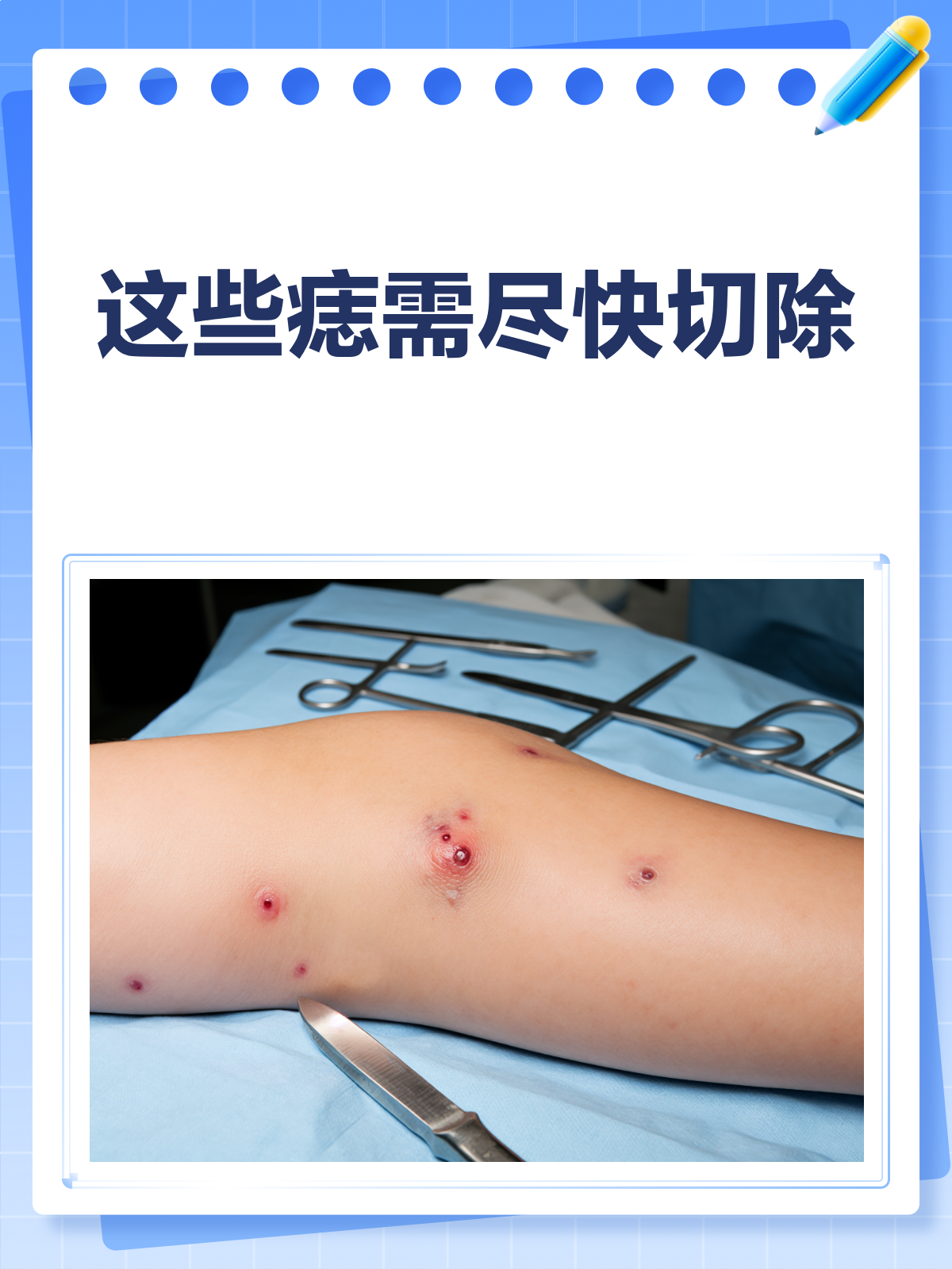 哪些肉痣必须切?看完这篇就明白!