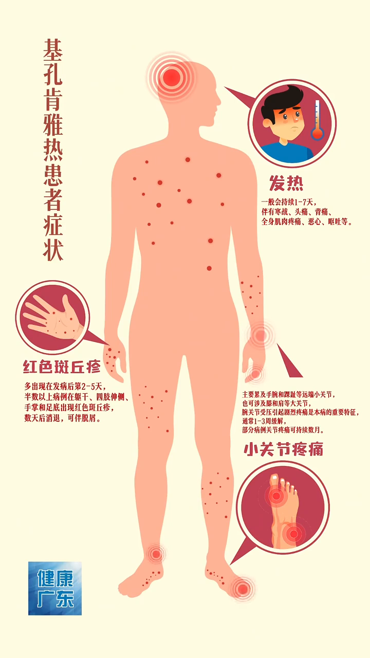 基孔肯雅热患者的症状主要有三大特点:发热、皮疹和关节疼痛