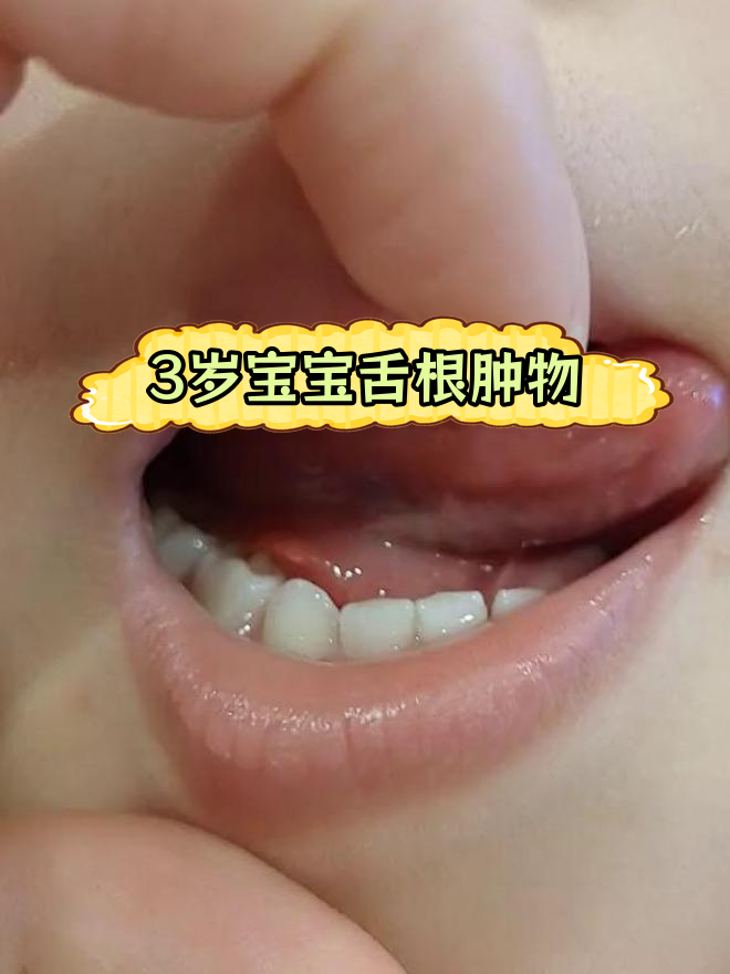 宝宝舌头下肉球原因解析