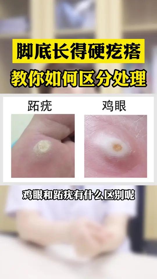 你脚上长的到底是鸡眼还是跖疣,你分清楚了吗