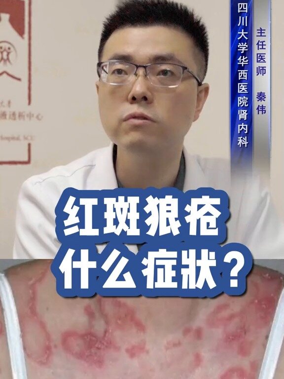 红斑狼疮有什么症状?华西医生给你讲讲