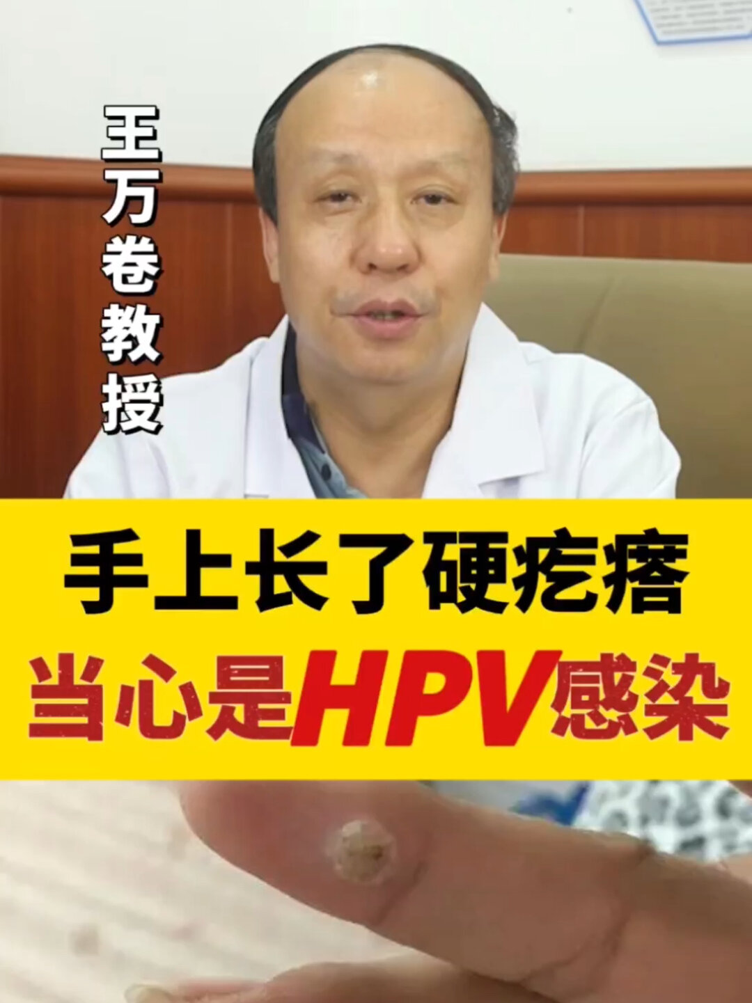 手上长“瘊子”,教你1招快速治好寻常疣