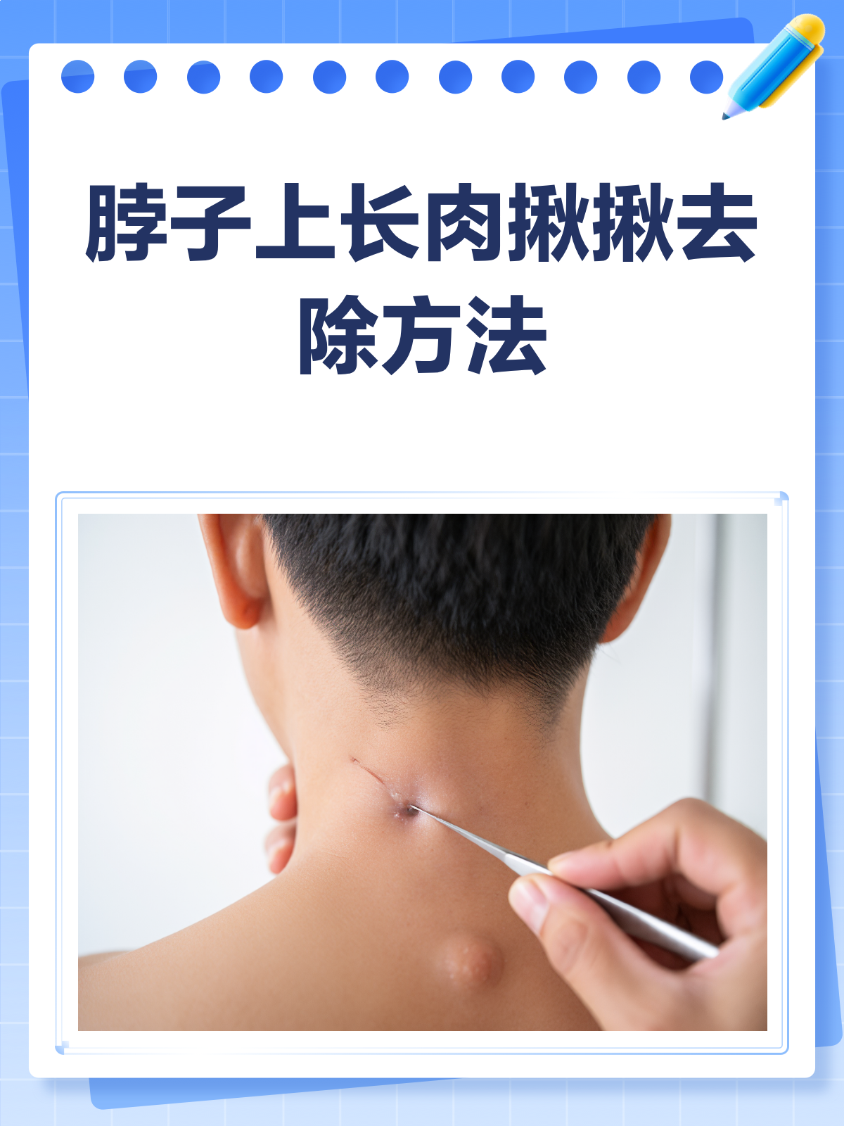 脖子上长肉揪揪?别急,这样去除更安全!
