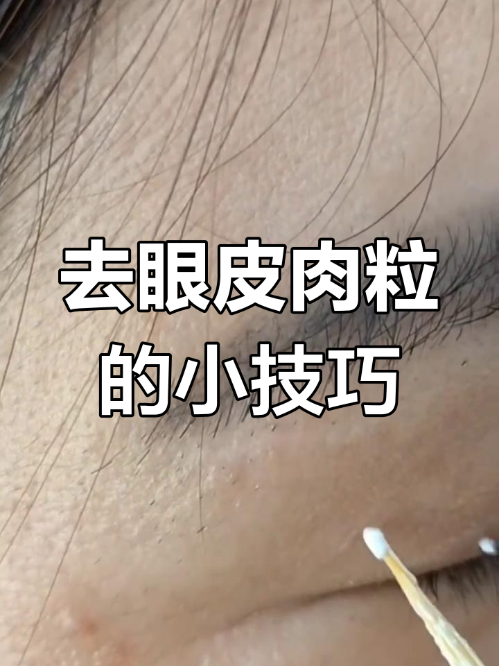 眼皮小肉粒轻松去除,牙签点涂法教你搞定