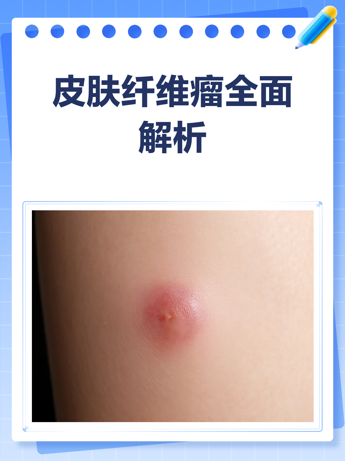 皮肤纤维瘤?别怕,一文读懂这个“小疙瘩”!