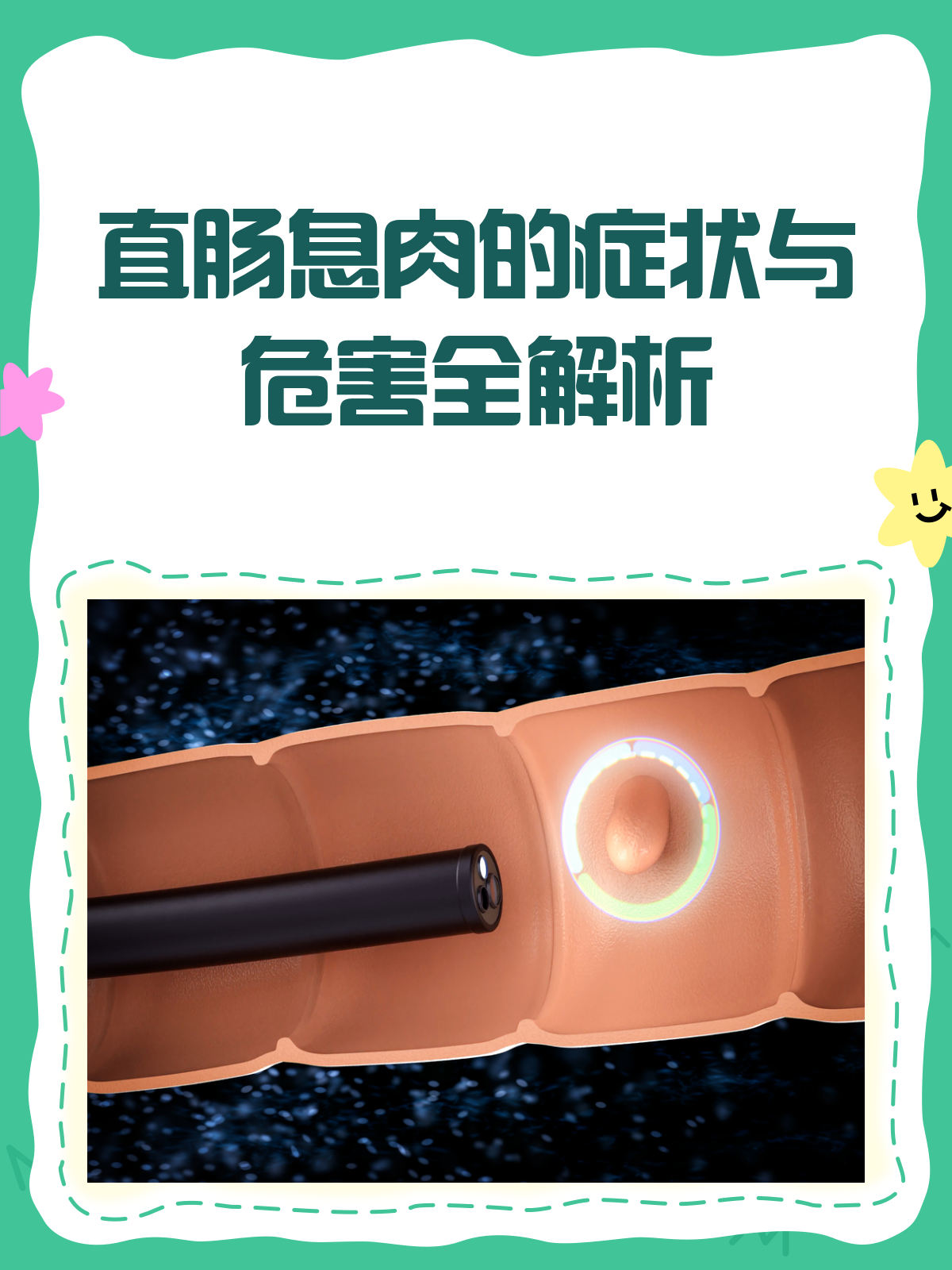 直肠息肉不容忽视！ 症状与危害大揭秘