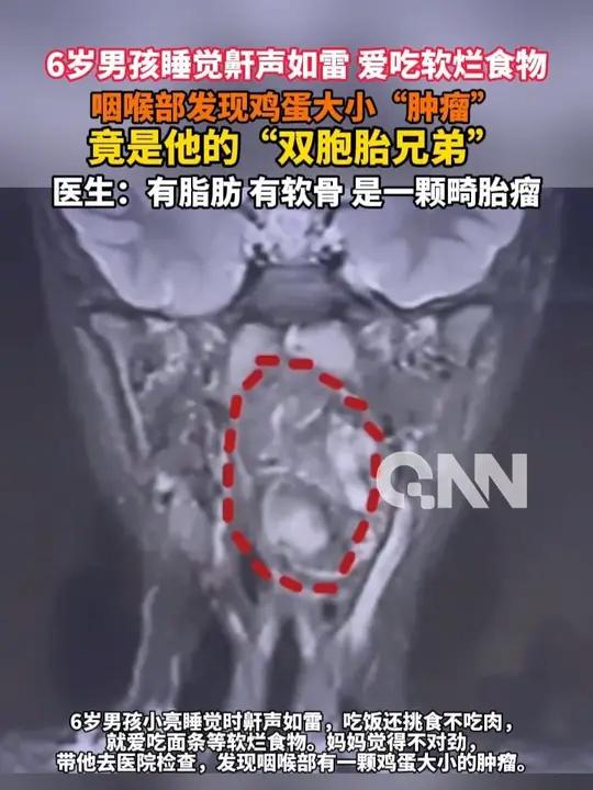6岁男孩睡觉鼾声如雷 爱吃软烂食物 咽喉部发现鸡蛋大小“肿瘤” 竟是他的“双胞胎兄弟” 医