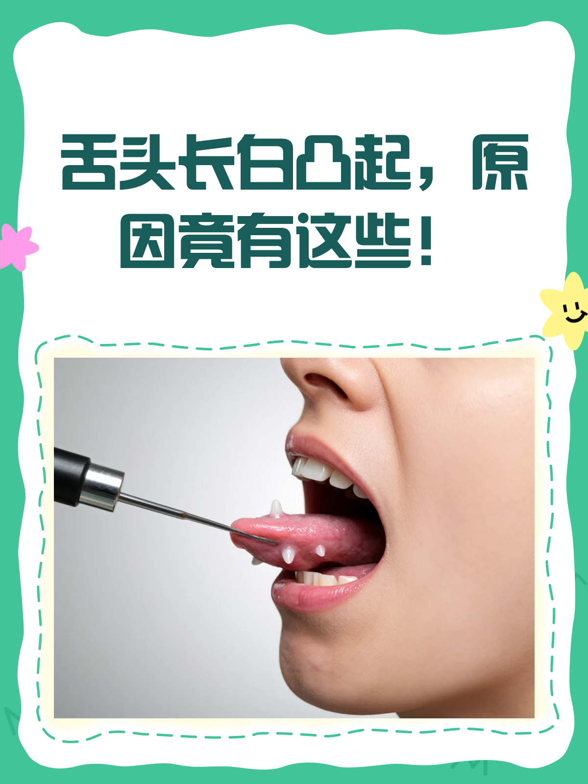 舌头上长了白色凸起物,是这些原因在作怪吗?