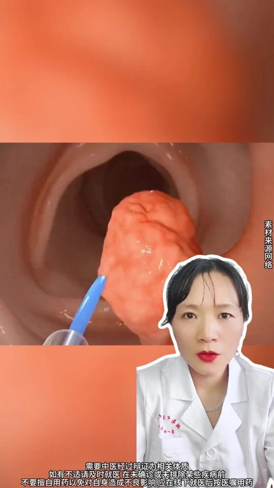 宫颈息肉需要掉吗?一篇讲明白!