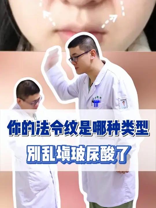 你的法令纹是哪种类型，别乱填玻尿酸了