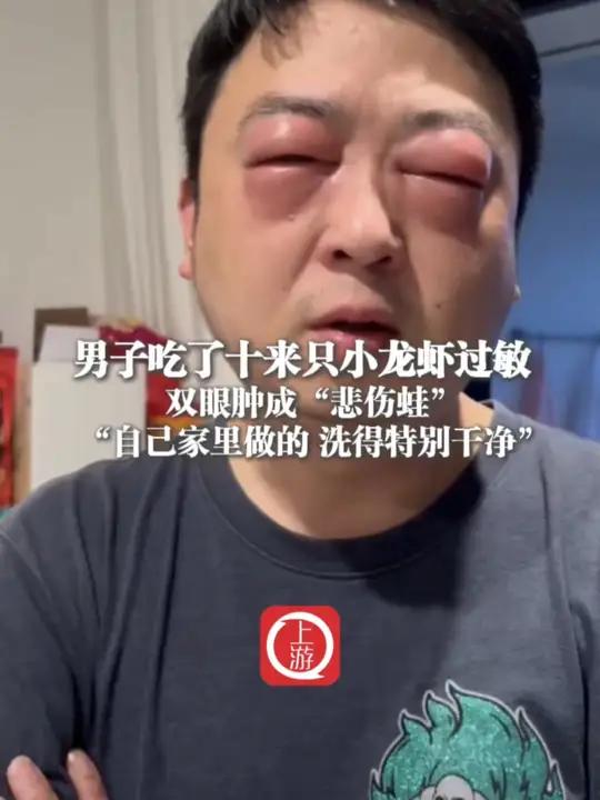5月4日(发布时间),江苏,男子吃了十来只小龙虾过敏双眼肿成“悲伤蛙” “自己家里做的 洗