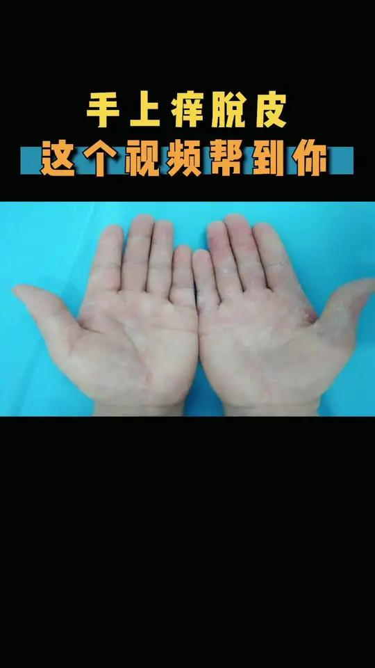 手上脱皮还长水泡,怎么办?皮肤科医生来帮你