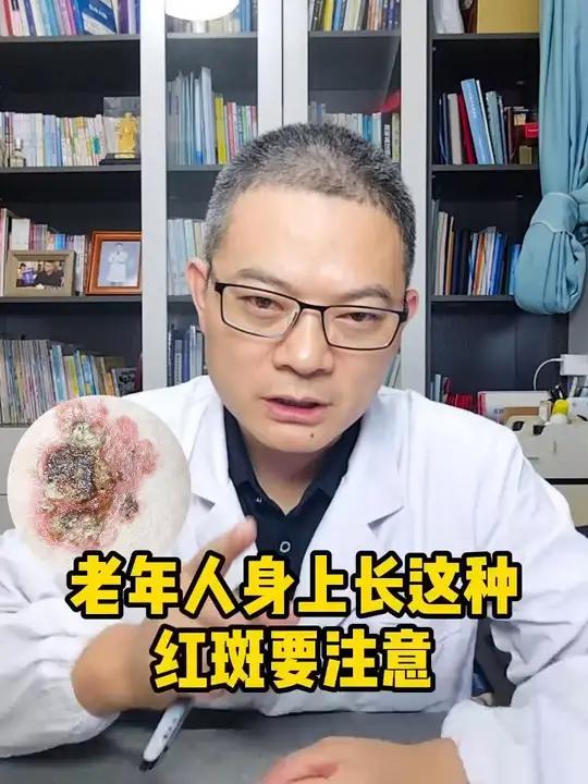 老年人身上长这种红斑要注意