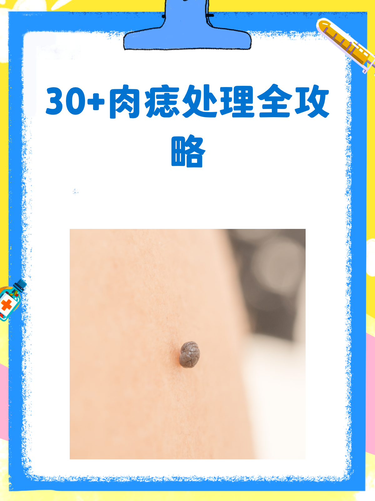 30+必看!肉痣处理全攻略♀