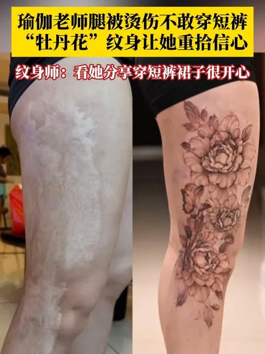 纹身的意义在这一刻具象化!女子多年前被烫伤不敢露腿,3朵“牡丹花”纹身让她重拾信心!纹身师