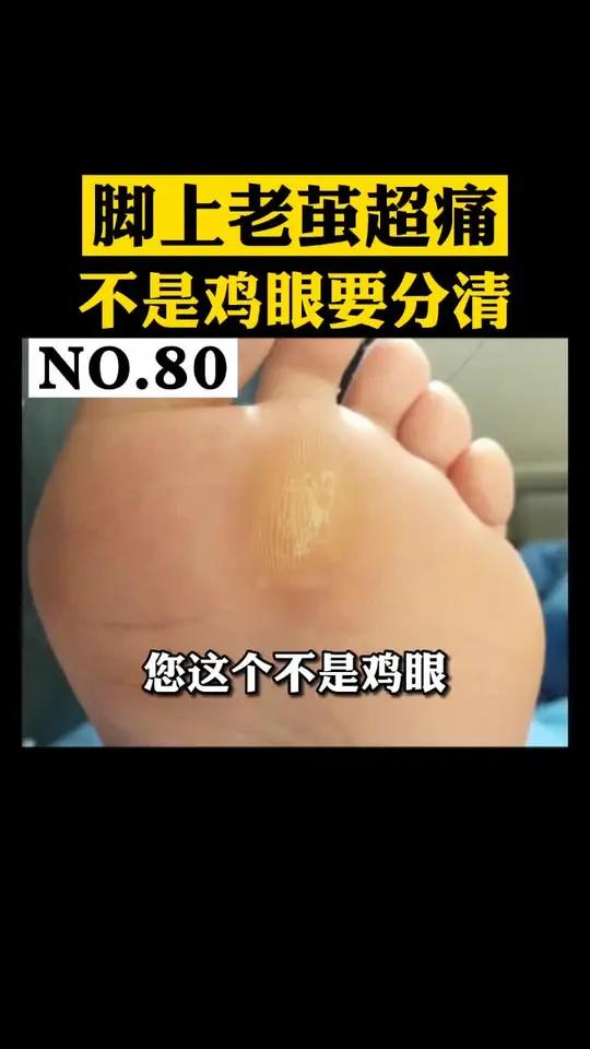胼胝和鸡眼,你能分清楚吗