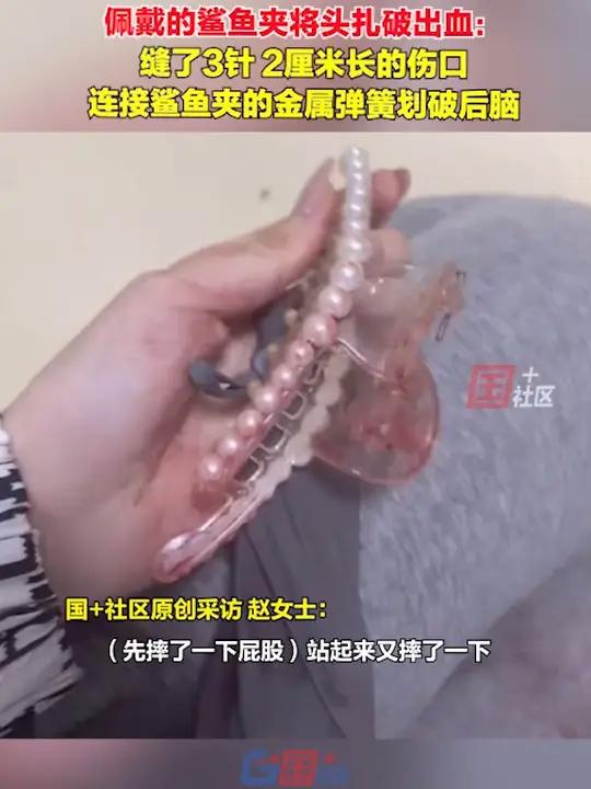 12月2日,吉林市一女子不慎滑倒,后脑撞到石墩,佩戴的鲨鱼夹将头扎破出血:缝了3针,2厘米