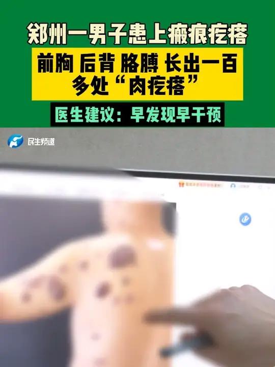 郑州一男子患上瘢痕疙瘩。前胸 后背 胳膊 长出一百多处“肉疙瘩”。医生建议：早发现早干预