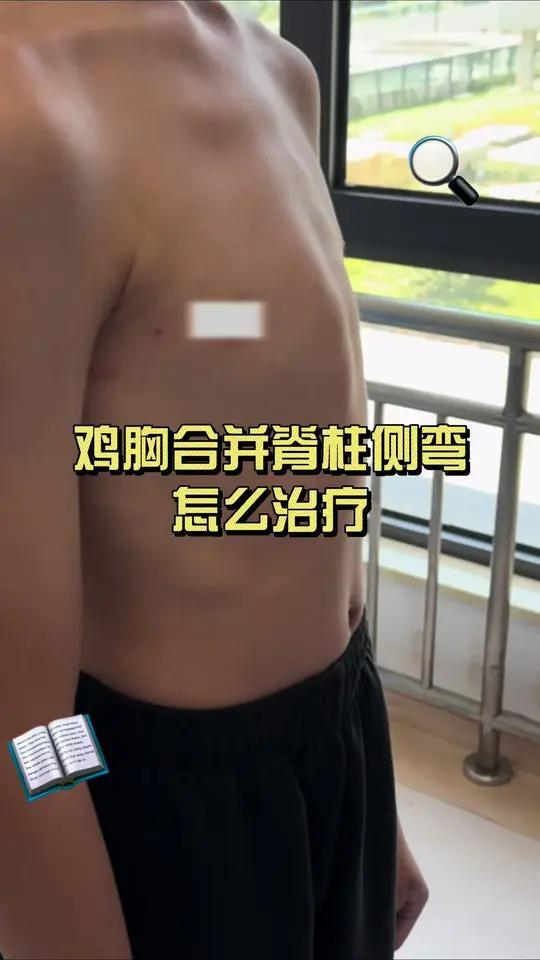 鸡胸合并脊柱侧弯怎么治疗