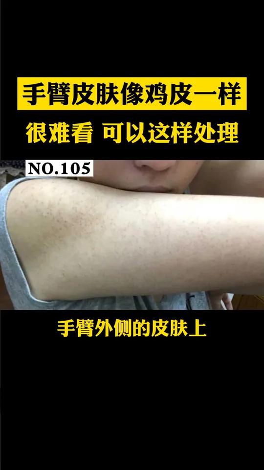 手臂皮肤上长密密麻麻的小疙瘩,摸着还很粗糙,很难看,这是毛周角化症也叫鸡皮肤可以这样处理