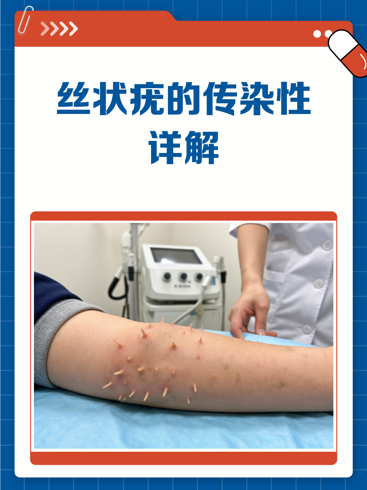 肉粒疣会传染吗?揭秘丝状疣的传染性!