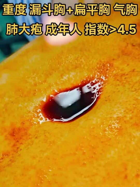重度 漏斗胸+ 扁平胸 气胸肺大疱19岁 成年人指数>4.5