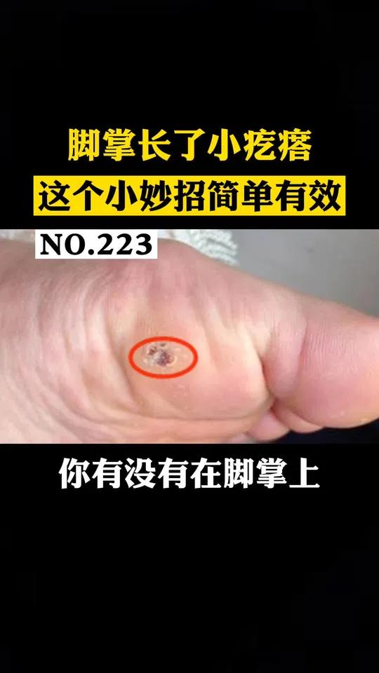 脚底长了一个小疙瘩,中间还有小黑点,这个是跖疣,很多人以为是鸡眼,这个小妙招简单处理,记得