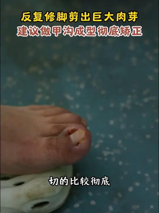 甲沟炎都是剪出来的 小伙反复修脚三四年 长出巨大肉芽