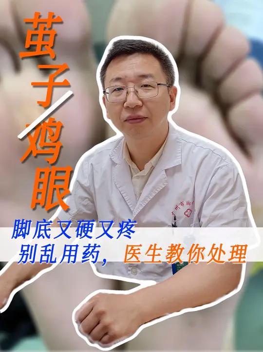 脚底硬硬不一定是鸡眼，也可能是茧子（胼胝）