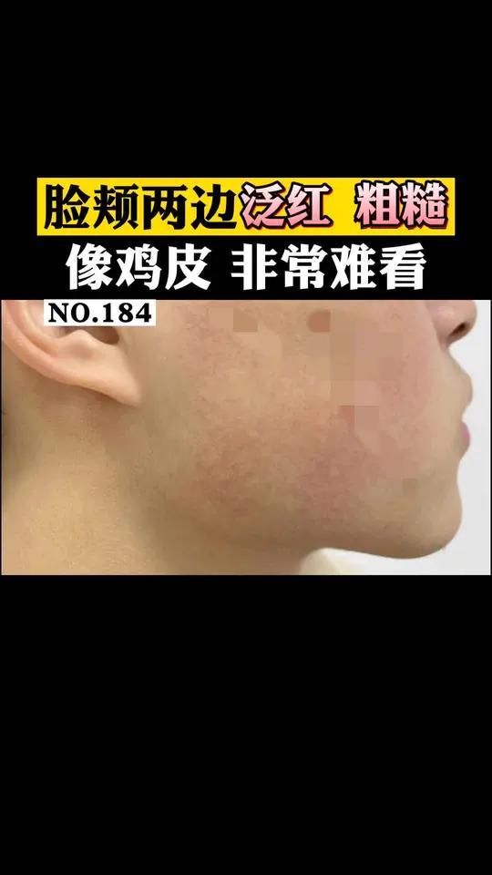 不仅身上有这种红色小颗粒,甚至脸上都有,非常难看,可以试试这个办法科普鸡皮肤 毛周角化