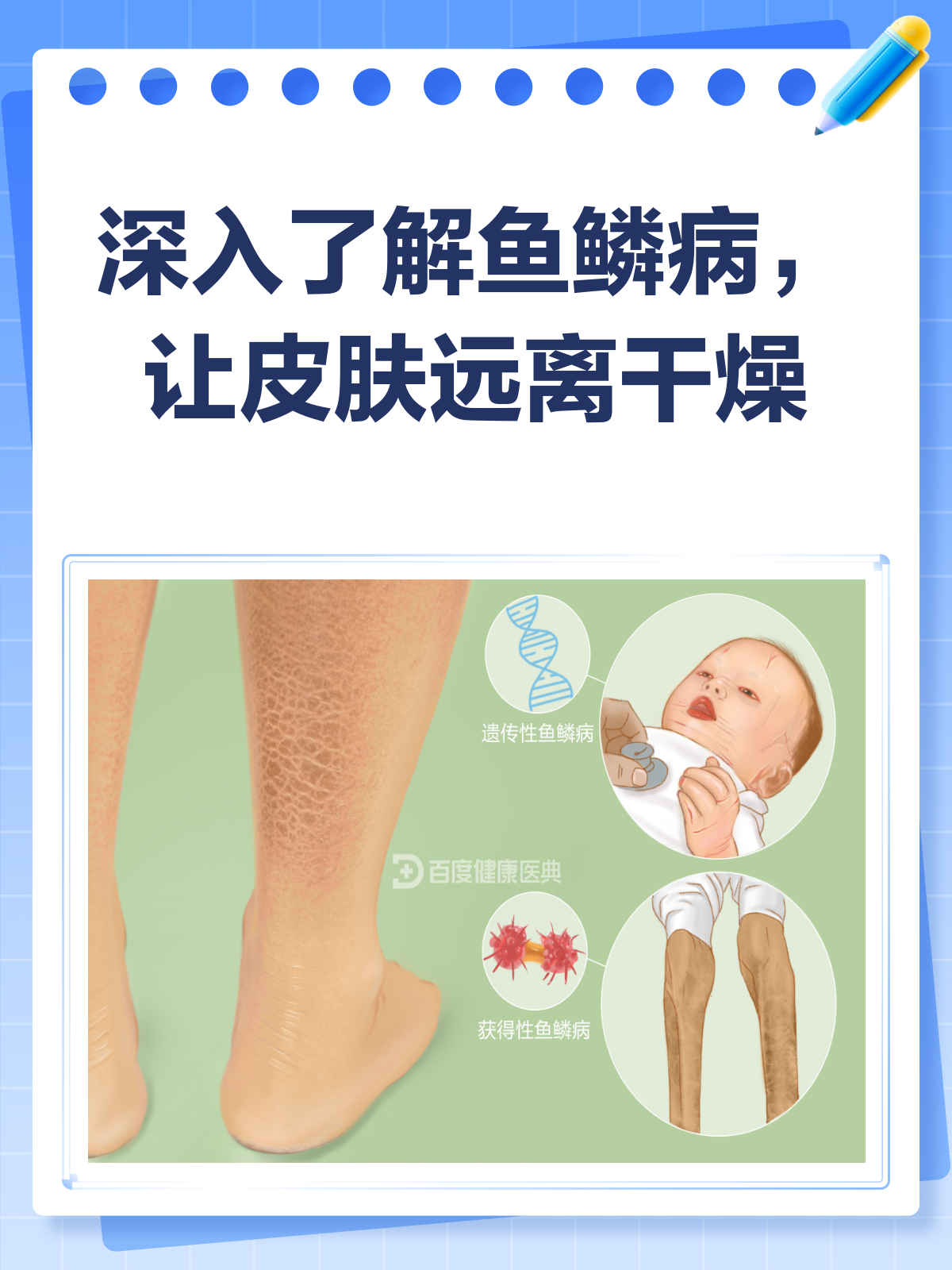 鱼鳞病来袭?了解它,才能战胜它!