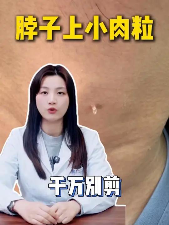 脖子上的小肉粒,千万别剪 #健康科普 #医生科普 #抖出健康知识宝藏 #传染病 #丝状疣
