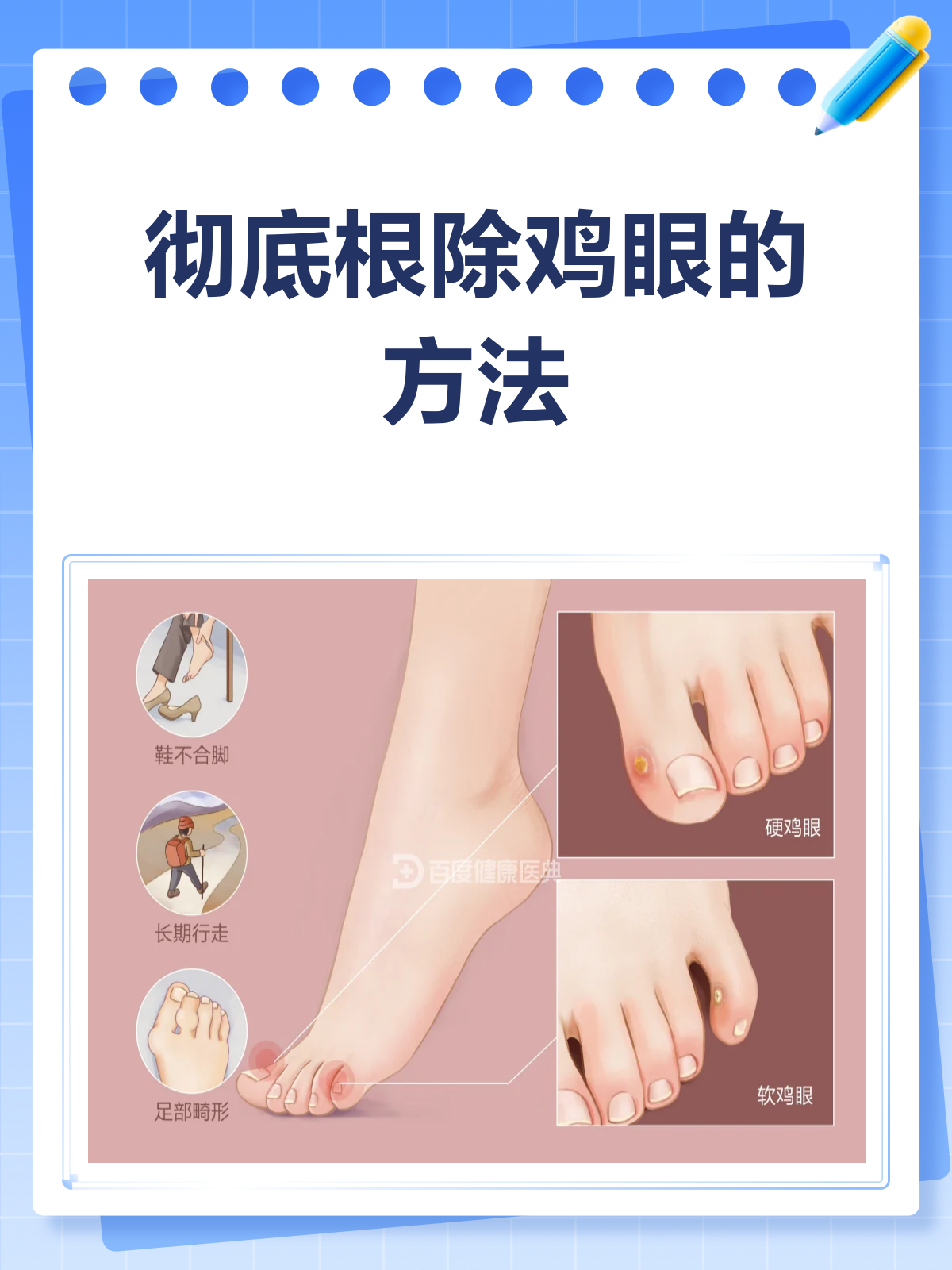 鸡眼烦恼别再有!彻底根除就看这一篇