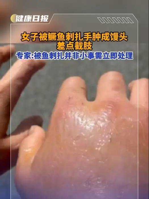 女子被鳜鱼刺扎手肿成馒头险截肢